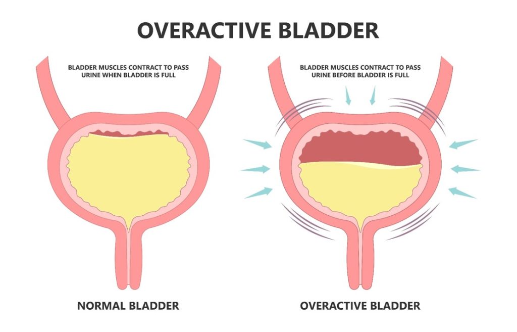 overactive bladder