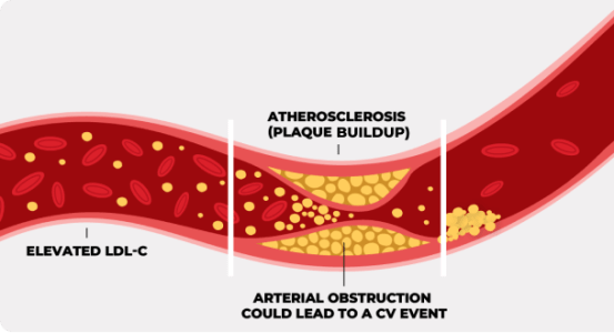 LDL and Atherosclerosis
