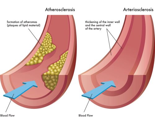 atherosclerosis-and-arteriosclerosis