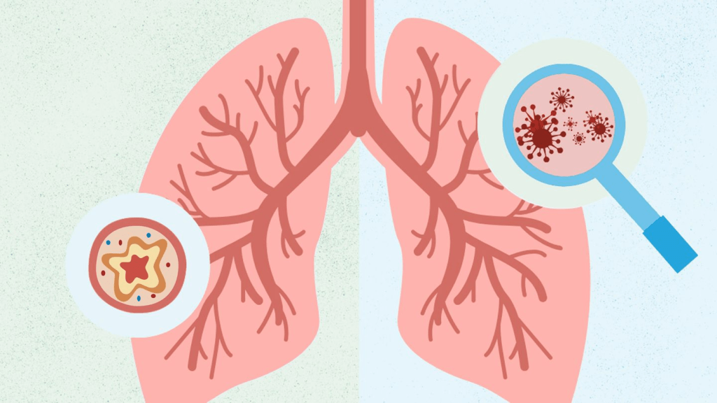 Bronchitis vs. Pneumonia Bronchitis vs. Pneumonia