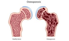 osteoporosis