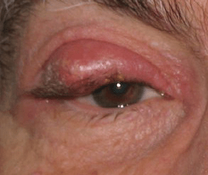 Symptoms of Chalazion