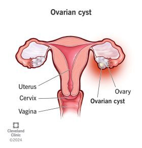 ovarian-cysts