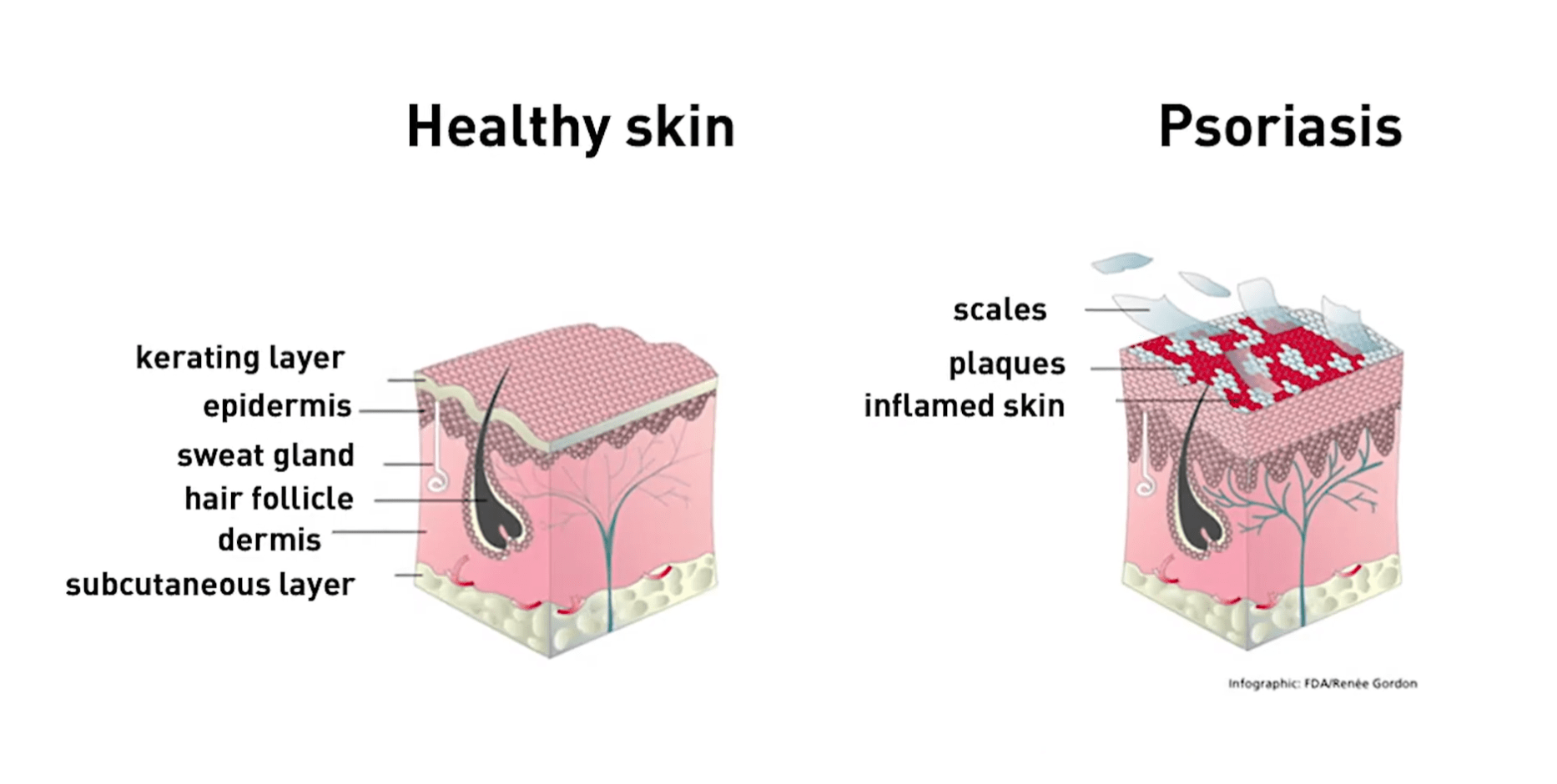 Psoriasis