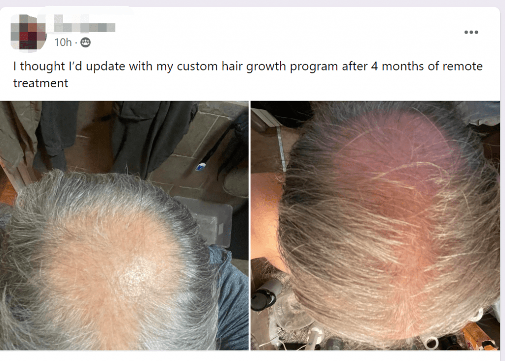 Result of my custom hair growth program after 4 months of remote treatment Result of my custom hair growth program after 4 months of remote treatment