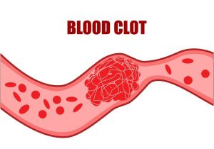 Blood Clot Blood Clot