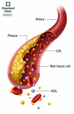 21656-hyperlipidemia-illustration 21656-hyperlipidemia-illustration