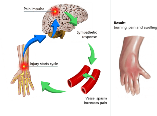 CRPS Pain