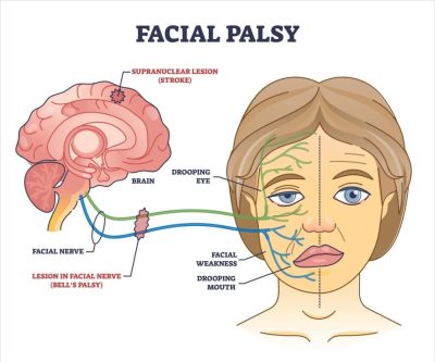 facial-palsy