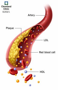 21656-hyperlipidemia-illustration 21656-hyperlipidemia-illustration