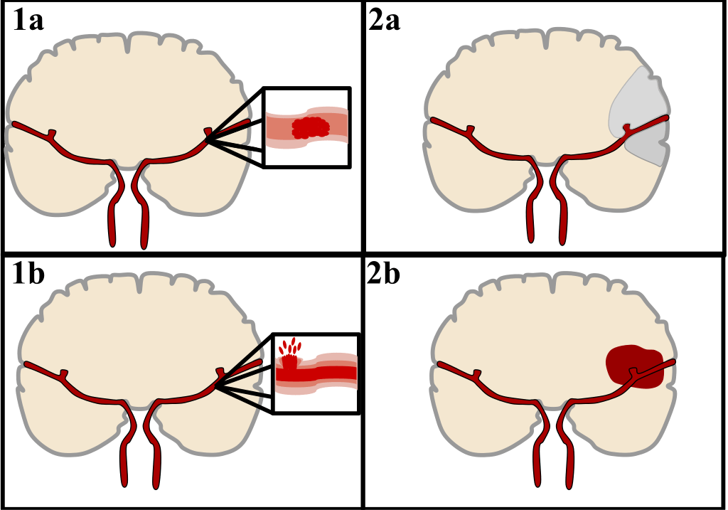 There are two main categories of stroke. Ischemic (top), typically caused by a blood clot in an artery (1a) resulting in brain death to the affected area (2a). Hemorrhagic (bottom), caused by blood leaking into or around the brain from a ruptured blood vessel (1b) allowing blood to pool in the affected area (2b) thus increasing the pressure on the brain.