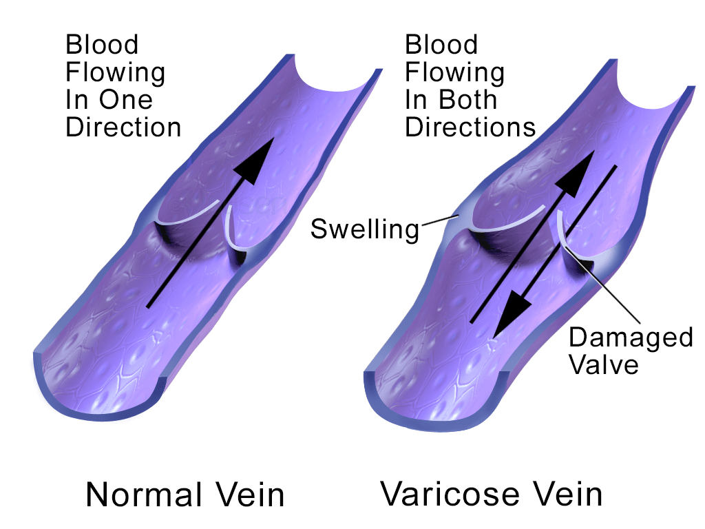 Comparison of healthy and varicose veins 