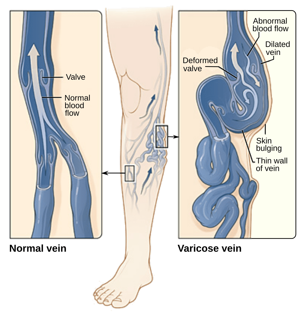How a varicose vein forms in a leg. Figure A shows a normal vein with a working valve and normal blood flow. Figure B shows a varicose vein with a deformed valve, abnormal blood flow, and thin, stretched walls. The middle image shows where varicose veins might appear in a leg.
