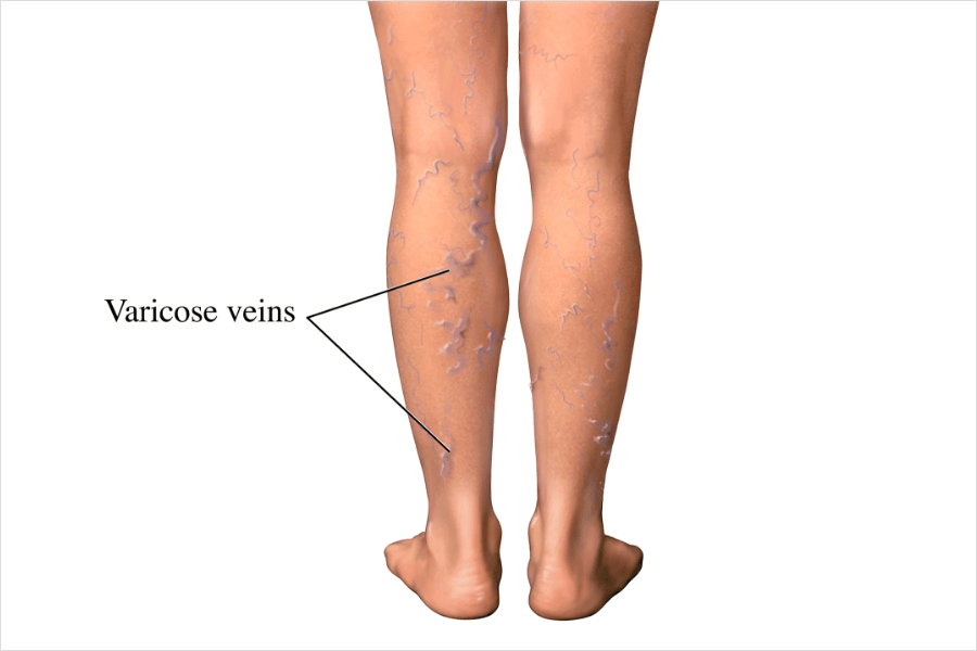 Varicose veins are swollen, twisted veins just under the skin. They can look like blue or purple squiggles in your legs. 