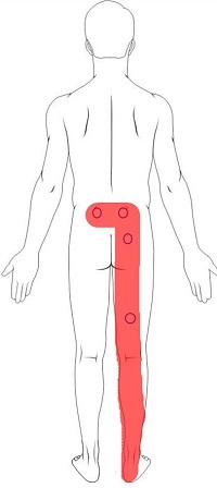 Sciatica
