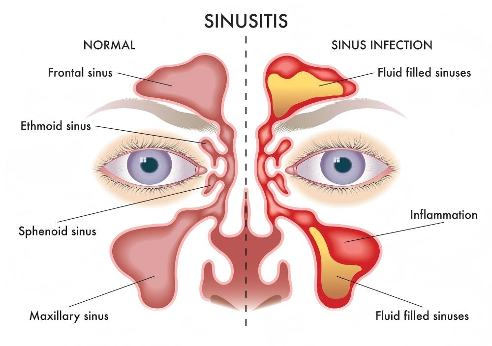 sinusitis infection sinusitis infection